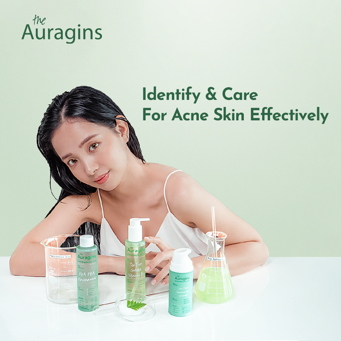 Identify & Care For Acne Skin Effectively